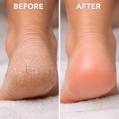 Urveso Callus Remover Pro - Urveso